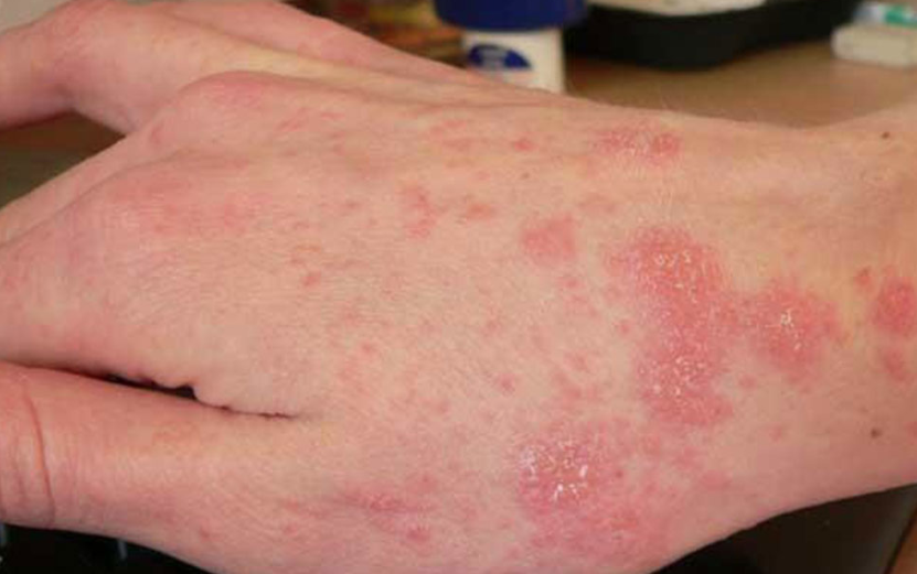 REPORTAN MÁS DE 93 CASOS DE SARNA HUMANA EN VILLAHERMOSA