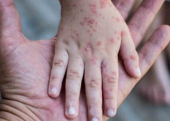 SUBEN LOS CASOS DE SARAMPIÓN EN LA CIUDAD DE MÉXICO