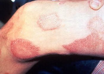 CONFIRMA LA SECRETARÍA DE SALUD CASOS DE LEPRA EN QUINTANA ROO Y YUCATÁN