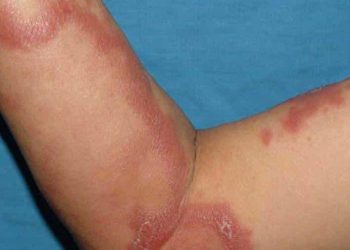 REPUNTE EN CASOS DE LEPRA