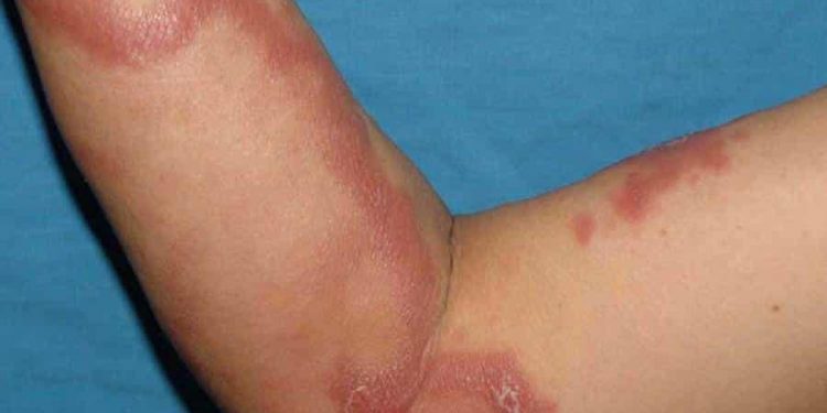 REPUNTE EN CASOS DE LEPRA