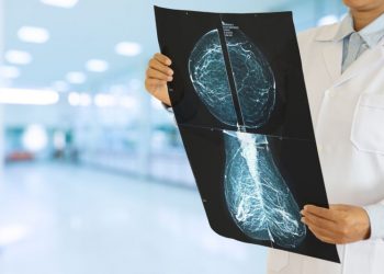 EL 86 % DE PACIENTES CON CÁNCER DE MAMA EN MÉXICO HA SUSPENDIDO TRATAMIENTO
