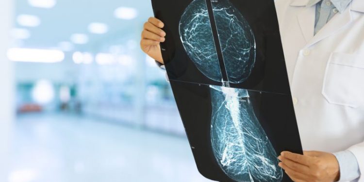 EL 86 % DE PACIENTES CON CÁNCER DE MAMA EN MÉXICO HA SUSPENDIDO TRATAMIENTO