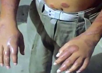 SIN RIESGO DE BROTE DE LEPRA EN TABASCO: SECRETARÍA DE SALUD