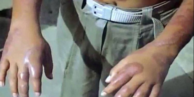 SIN RIESGO DE BROTE DE LEPRA EN TABASCO: SECRETARÍA DE SALUD