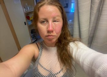 BARISTA DE CANCÚN LE QUEMA EL ROSTRO A UNA TURISTA MIENTRAS LE PREPARABA BEBIDA FLAMEADA