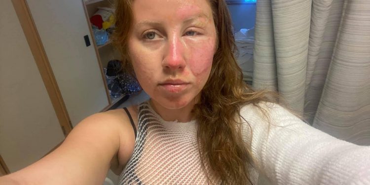 BARISTA DE CANCÚN LE QUEMA EL ROSTRO A UNA TURISTA MIENTRAS LE PREPARABA BEBIDA FLAMEADA