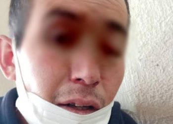 FALLECE PACIENTE CON SÍNTOMAS DE «HONGO NEGRO» EN EDOMEX