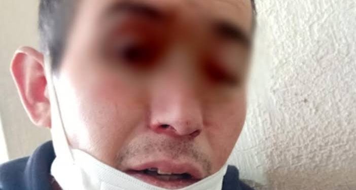 FALLECE PACIENTE CON SÍNTOMAS DE «HONGO NEGRO» EN EDOMEX