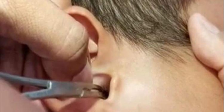 Le encuentran 4 garrapatas dentro del oído a un menor