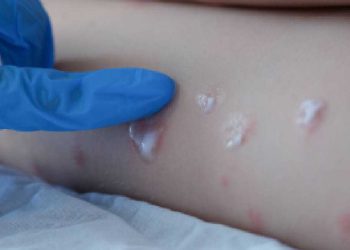 Estados Unidos reporta primer caso de viruela del mono