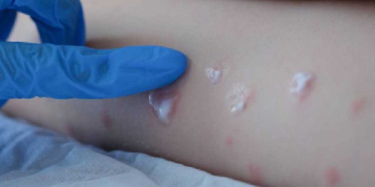 Estados Unidos reporta primer caso de viruela del mono