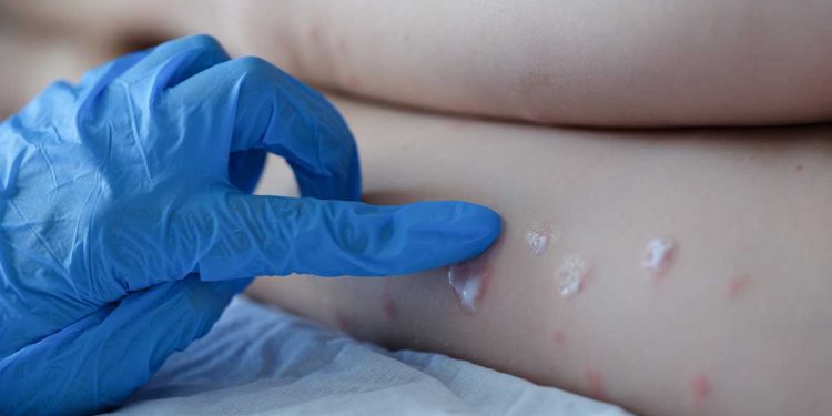 Reportan cinco casos de viruela de mono en México