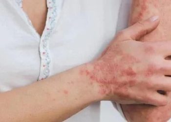 Viruela del mono no provoca cambio en el semáforo epidemiológico de Quintana Roo