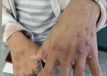 Se darán más casos de Viruela Símica