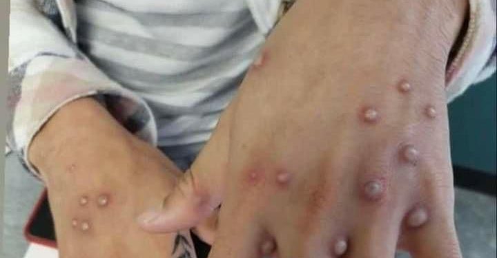 Se darán más casos de Viruela Símica