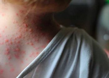 Jalisco reportó nuevos casos de viruela del mono