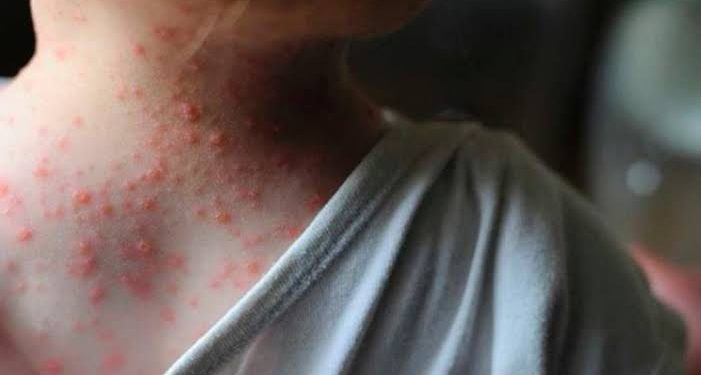 Jalisco reportó nuevos casos de viruela del mono