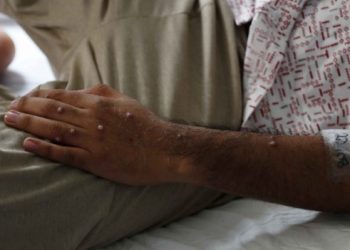 Expertos aseguran que la vacuna contra la viruela aplicada en los 70’s no protege contra la del mono
