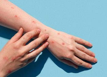 En México reportan más de 100 casos nuevos de viruela del mono; ya suman 504