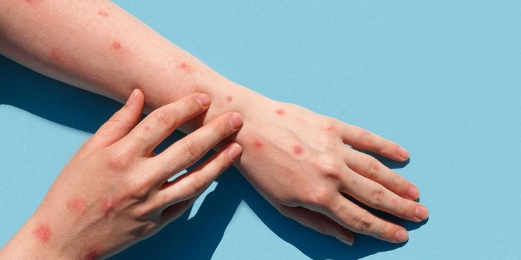 En México reportan más de 100 casos nuevos de viruela del mono; ya suman 504