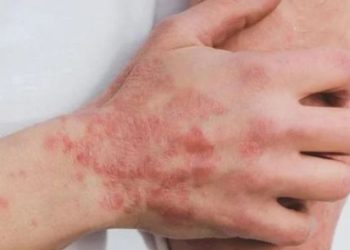 Confirman 7 contagios de viruela del mono en Tabasco