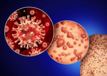 OMS registra mil 51 casos de viruela símica en todo México