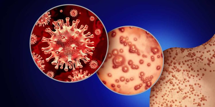 OMS registra mil 51 casos de viruela símica en todo México