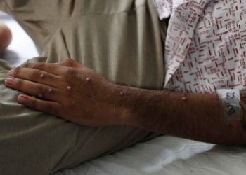 Confirman primer muerte por viruela del mono en EU