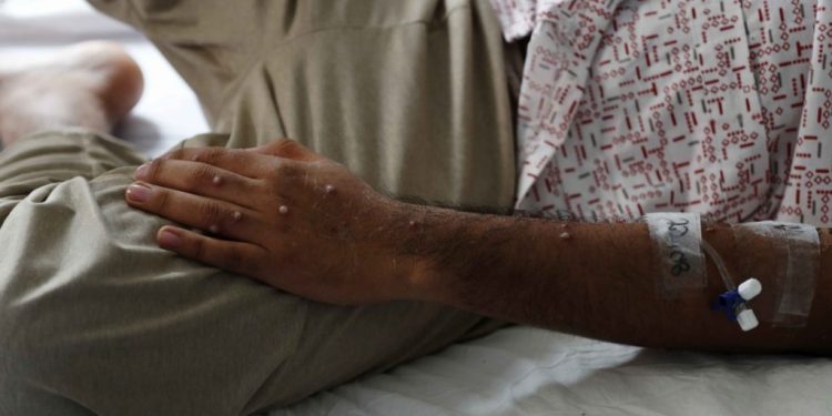 Confirman primer muerte por viruela del mono en EU