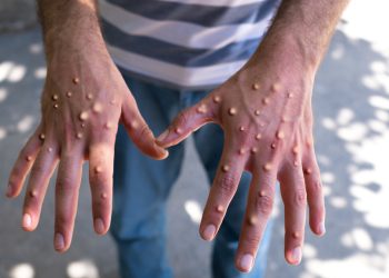 Secretaría de Salud confirma 788 contagios de viruela del mono en México