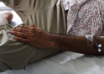 Aumentan casos de viruela símica en Quintana Roo y Yucatán