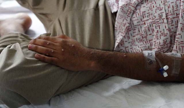 Aumentan casos de viruela símica en Quintana Roo y Yucatán