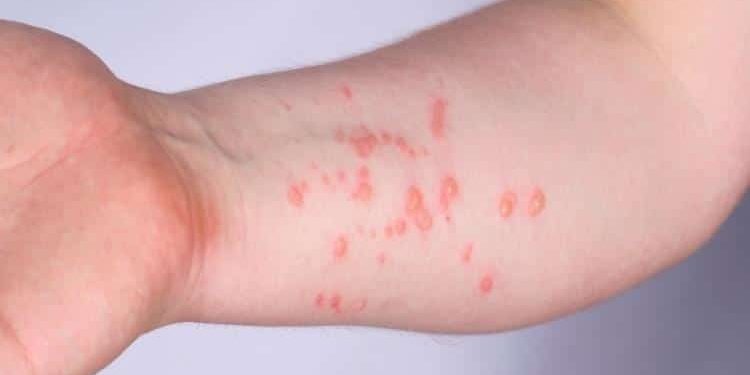 Reportan 47 casos de viruela símica en Tabasco