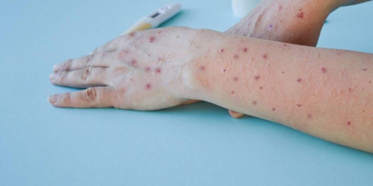 OMS decide mantener el nivel de alerta máxima para la Viruela del mono