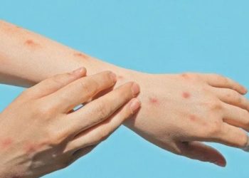 Se confirmaron las primeras dos defunciones por Mpox (viruela símica) en Yucatán