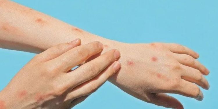 Se confirmaron las primeras dos defunciones por Mpox (viruela símica) en Yucatán