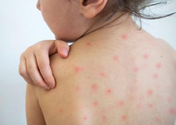Tabasco libre de casos de sarampión durante tres años: Salud