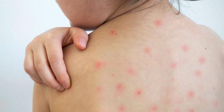 Tabasco libre de casos de sarampión durante tres años: Salud