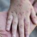 Alerta por resurgimiento de Sarampión, altamente contagioso: UNAM