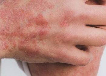 Tabasco reporta más de 400 casos de escabiosis o «sarna humana»