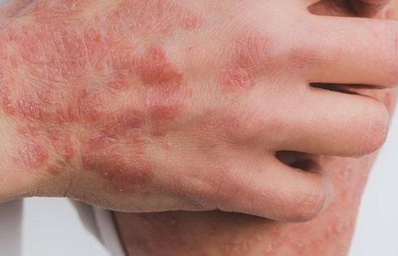 Tabasco reporta más de 400 casos de escabiosis o «sarna humana»