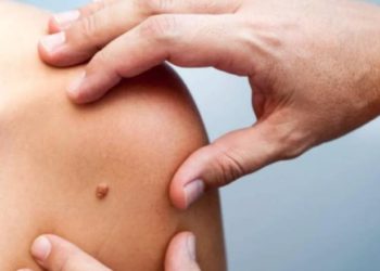 Realizan Jornada de Detección de Cáncer de Piel en el Juan Graham
