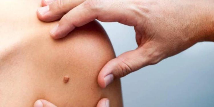 Realizan Jornada de Detección de Cáncer de Piel en el Juan Graham