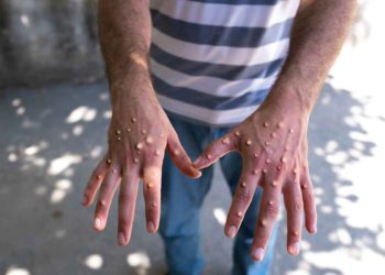 Aumenta el número de casos confirmados de viruela símica en Quintana Roo