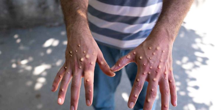 Aumenta el número de casos confirmados de viruela símica en Quintana Roo