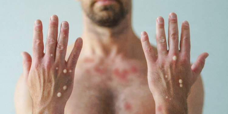 Tabasco libre de contagios de Mpox, informa gobernador Merino