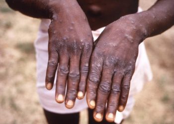 Detectan primer caso de mpox fuera de África