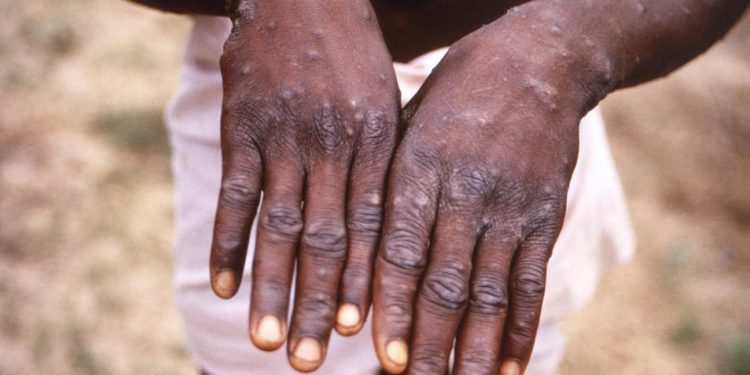 Detectan primer caso de mpox fuera de África