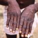 Detectan primer caso de mpox fuera de África